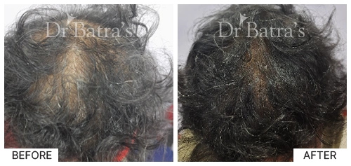 Hair Falling Treatment